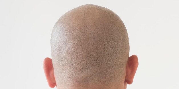 Back view of patient with shaved head