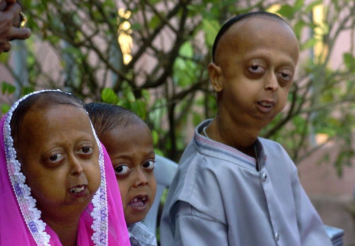 black kids with progeria