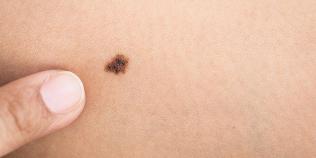 Macro black birthmark on skin