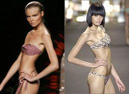anorexia in modeling industry