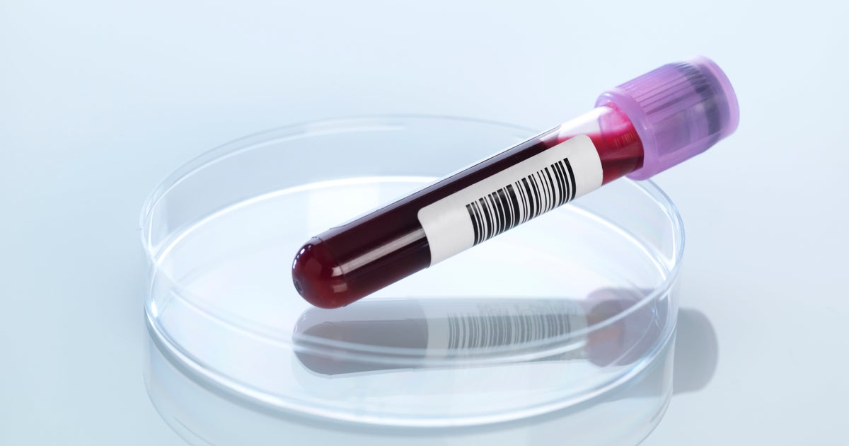 New Blood Test That Detects Pancreatic Cancer Early Could