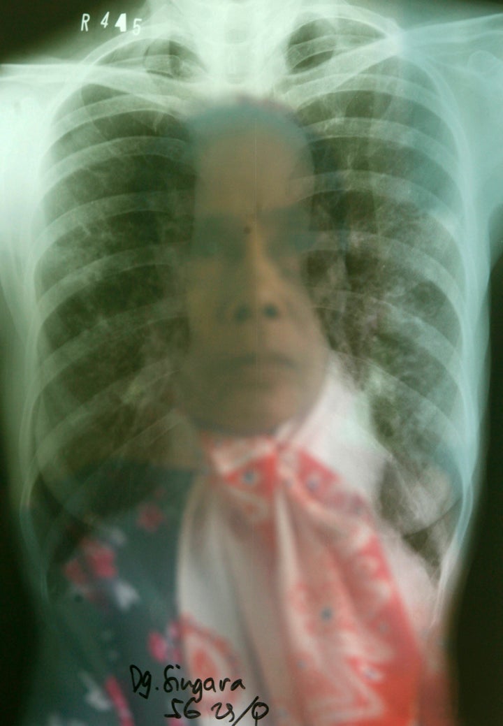 Tuberculosis As A Major Health Problem