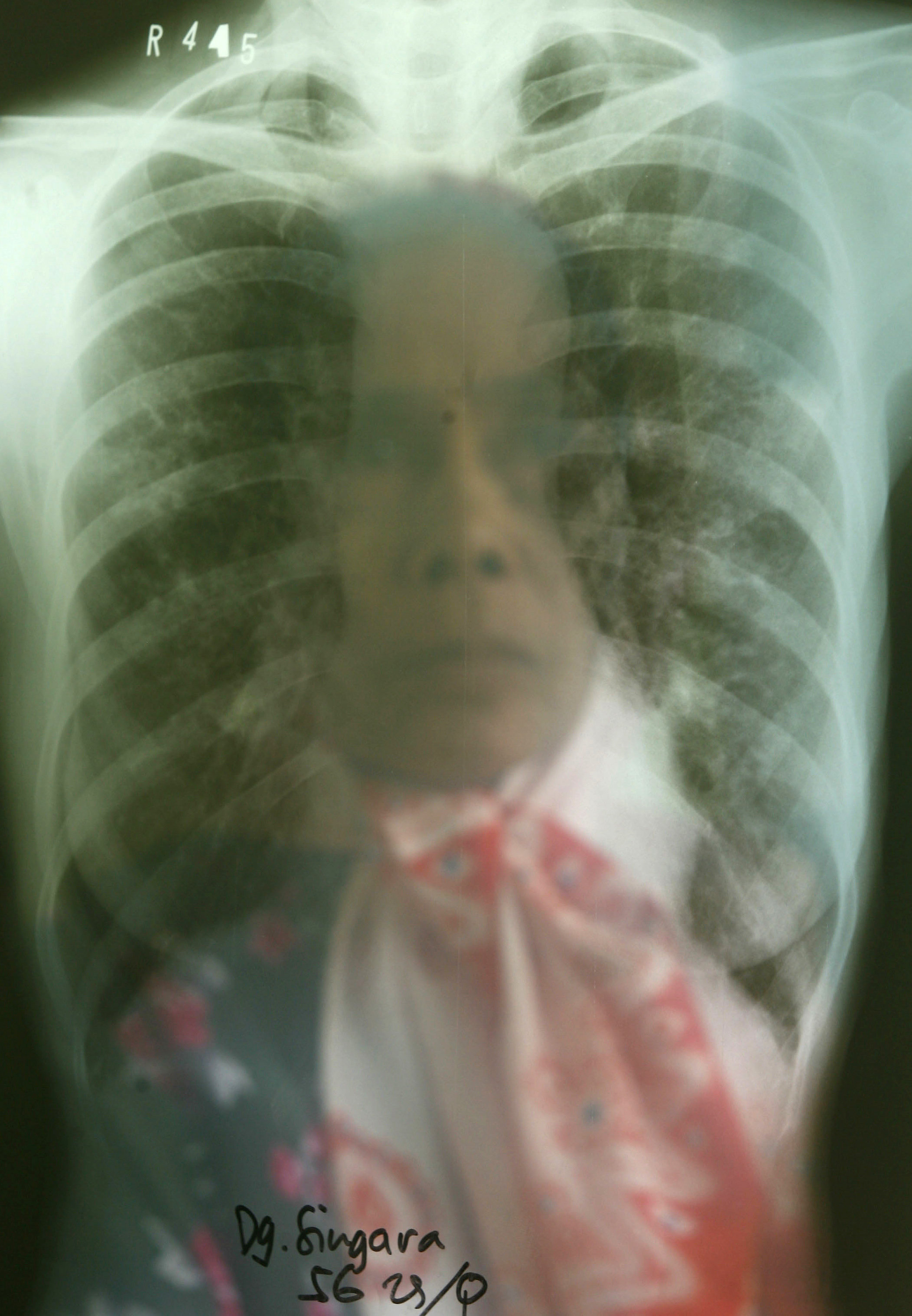 Tuberculosis Remains World’s Top Infectious Killer, But A Turning Point ...