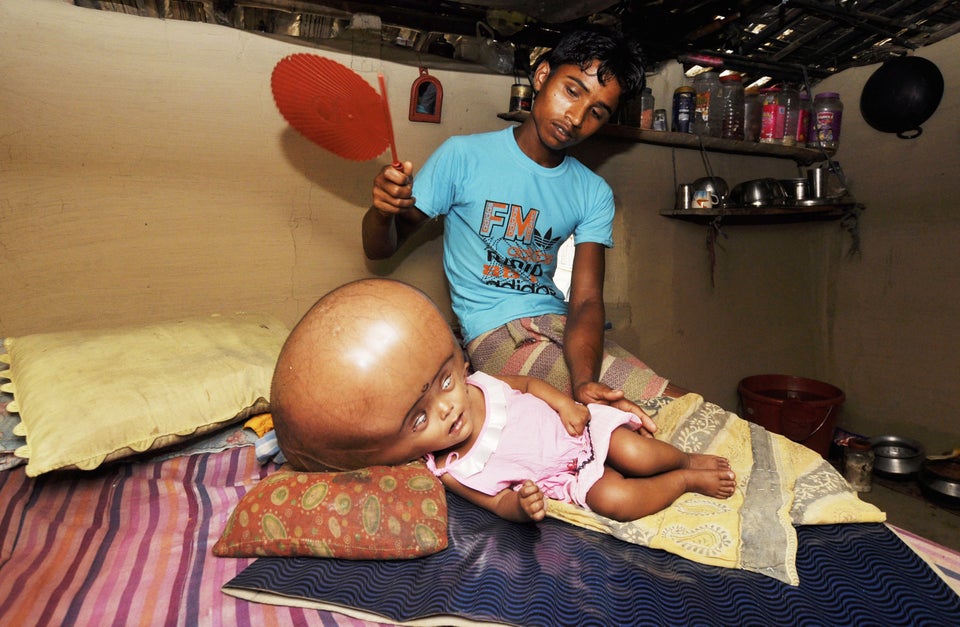 Runa Begum, Child With Hydrocephalus