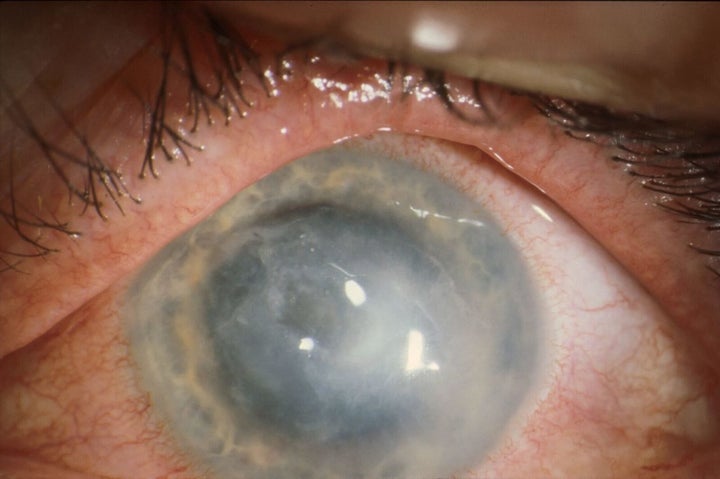 A severe case of the eye infection Acanthamoeba keratitis.