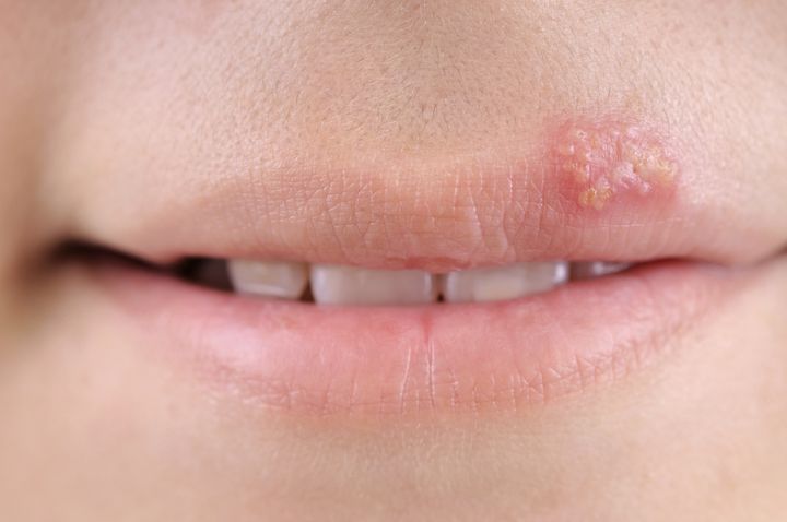 close up of lips affected by...