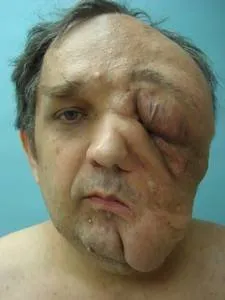 Man with huge face tumor reveals surgery results