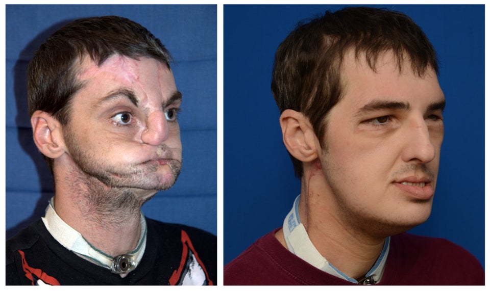 Falloplastica Prima E Dopo Foto Richard Lee Norris, Face Transplant Patient, No Longer 'Living As A
