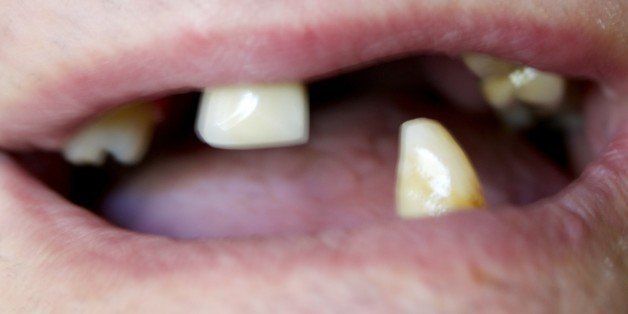 Toothless Man Allegedly Gums Roommate Who Wouldnt Clean His Ear HuffPost