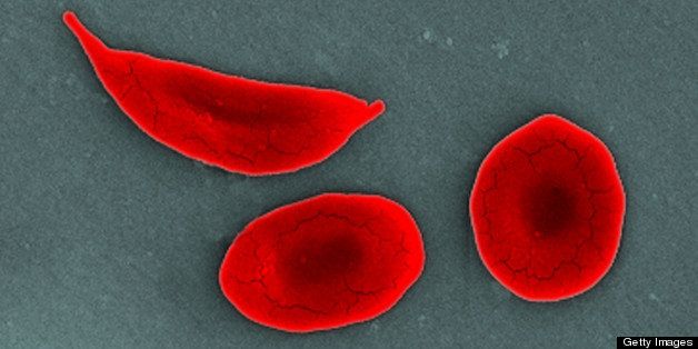 Scanning electron micrograph (SEM) comparing 2 normal red blood cells (RBCs), with a sickle cell RBC (left) found in a blood specimen of an 18 year old female patient with sickle cell anemia, (HbSS). People who have this form of sickle cell disease inherit two sickle cell genes (S), one from each parent. This is commonly called sickle cell anemia, and is usually the most severe form of the disease. Sickle cell disease is a group of inherited red blood cell disorders. Healthy red blood cells are round, and they move through small blood vessels to carry oxygen to all parts of the body. In sickle cell disease, the red blood cells become hard and sticky and look C-shaped like a sickle. The sickle cells die early, which causes a constant shortage of red blood cells. Also, when they travel through small blood vessels, they get stuck and clog the blood flow. This can cause pain and other serious problems.