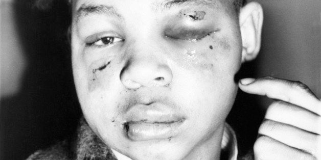 Lamar Howard, 19, of Monroe, Ga., points to bruises he reports to have received in Atlanta, Jan. 2, 1947, from two white men.