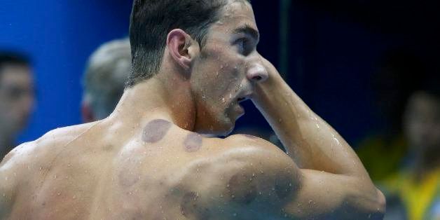 2016 Rio Olympics - Swimming - Preliminary - Men's 200m Butterfly - Heats - Olympic Aquatics Stadium - Rio de Janeiro, Brazil - 08/08/2016. Michael Phelps (USA) of USA is seen with red cupping marks on his shoulder as he competes. REUTERS/Michael Dalder FOR EDITORIAL USE ONLY. NOT FOR SALE FOR MARKETING OR ADVERTISING CAMPAIGNS. 