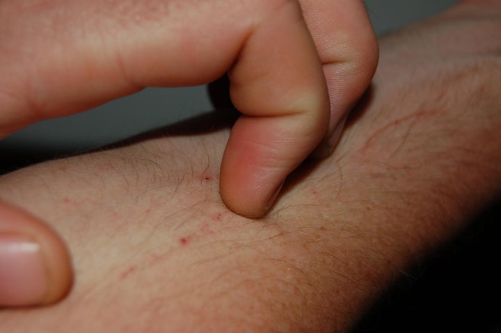 Description 1 A hand scratching at a pruritus on arm | Source | Author Orrling and Tomer S. | Date 2010-04 | Permission | ot