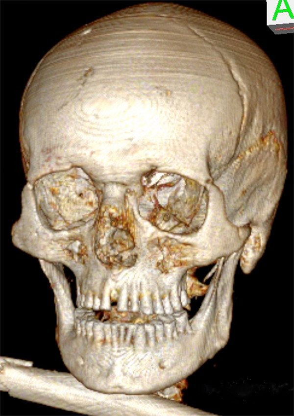 Otzi The Iceman Had Tooth Decay Cavities Severe Gum Disease New Study Shows Images Huffpost