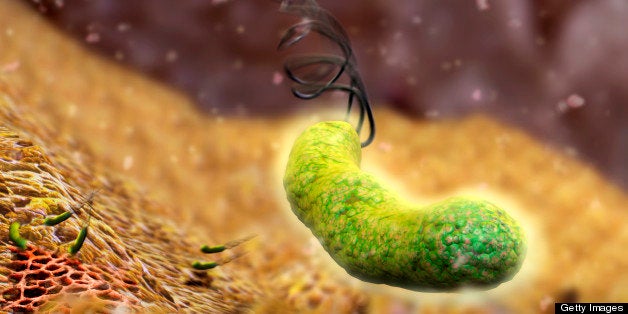 Helicobacter pylori bacteria. Computer artwork of Helicobacter pylori bacteria in a human stomach. Formerly known as Campylobacter pyloridis, these are spiral-shaped Gram-negative bacteria. The terminal flagella (hair-like structures) are used for locomotion. Colonies of H. pylori are found in the mucus lining of the stomach. They cause gastritis, and are also the most common cause of stomach ulcers. H. pylori may also be a cause or co-factor for gastric cancer, as its presence increases the risk of developing stomach tumours.