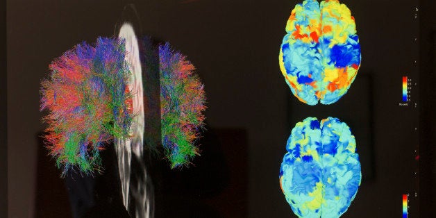 TORONTO - APRIL 25 - White matter fibre tracts (left) and fMRI images of reporter Jennifer Wells's brain on April 25, 2014. (Rick Madonik/Toronto Star via Getty Images)