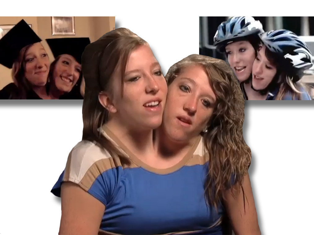 are abby and brittany hensel conjoined twins married