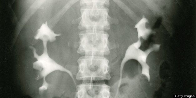 This X-ray shows a patient with polycystic kidney disease. PKD is a genetic disorder that can affect not only the kidneys, but other organs as well, including the liver and pancreas.