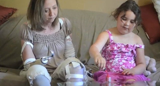 California mum has her arms and legs amputated after eating