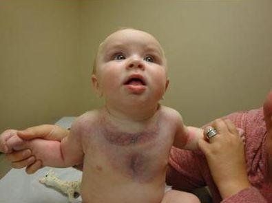 Donors Help Baby With Rare Disease