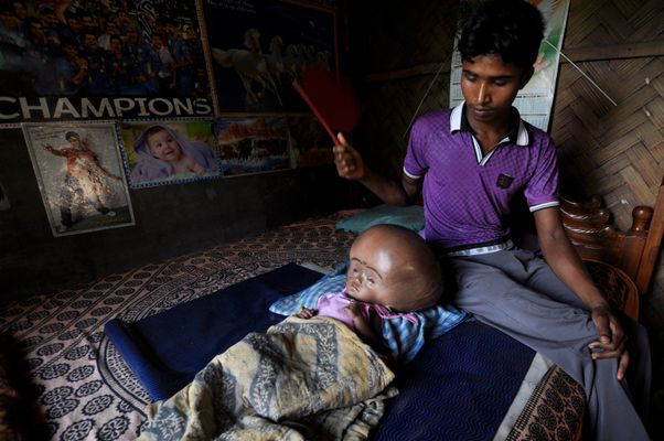Runa Begum, Girl In India With Swollen Head, Offered Help By Fortis  Hospital To Treat Hydrocephalus | HuffPost
