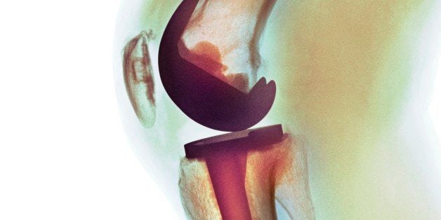 Knee replacement. Coloured X-ray of a total knee replacement in a 70 year old man.