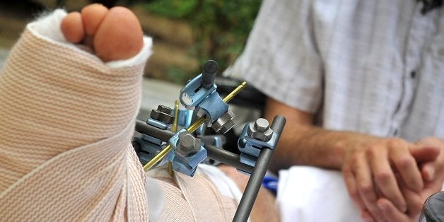 A network of braces and supports keep Gregory Hein's leg in place as he talks about his ordeal in the Sierra for six days with a badly broken leg during a news conference at Community Regional Medical Center's Rose Garden in Fresno on July 15, 2014. (John Walker/Fresno Bee/MCT via Getty Images)