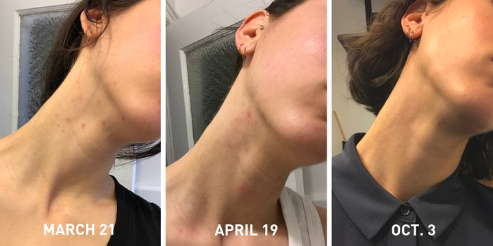 How I Treated The Hormonal Acne I Got From Birth Control Huffpost Life 