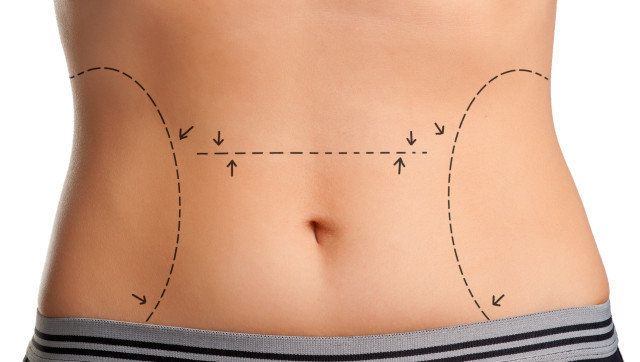 tummy marked for plastic surgery