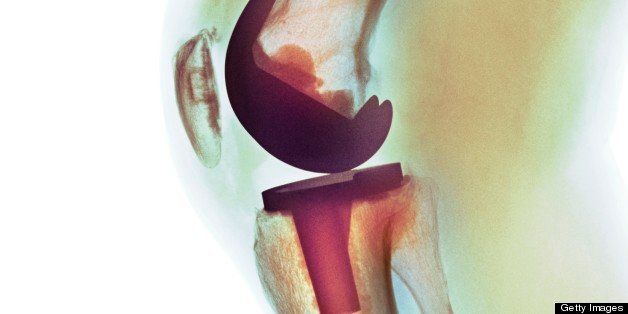 Knee replacement. Coloured X-ray of a total knee replacement in a 70 year old man.