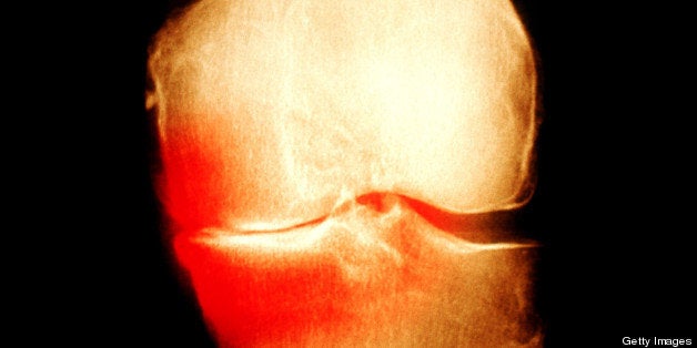 Osteoarthritis: What You Need to Know | HuffPost Post 50