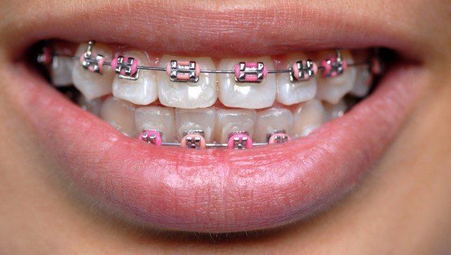 fake braces
