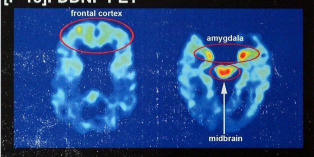 Recent brain scans of NFL hall of famer Joe DeLamielleure, who was diagnosed with CTE, the brain injury that is affecting so many former football players. (Jeff Siner/Charlotte Observer/MCT via Getty Images)