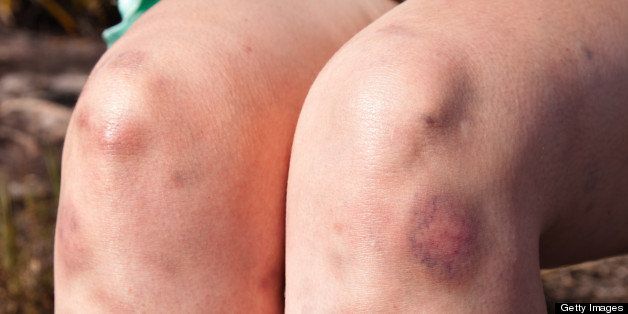 Young woman scrubbing healing cream on multiple leg bruises