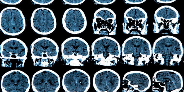 MRI scan of the human brain