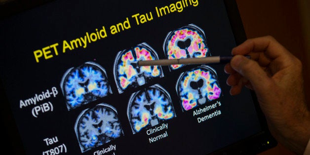 R. Scott Turner, Professor of Neurology and Director of the Memory Disorder Center at Georgetown University Hospital, points to PET scan results that are part of a study on Allheimer's disease at Georgetown University Hospital, on Tuesday, May 19, 2015, in Washington. Amyloid plaques are the Alzheimerâs culprit that gets all the attention. Now scientists are beginning to peer into the brains of people considered at high risk of getting Alzheimerâs to see if the diseaseâs other bad actor, tangle-forming tau, is lurking well before any memory symptoms begin. (AP Photo/Evan Vucci)