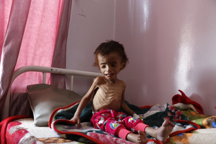 A malnourished child receives treatment at the Sabeen hospital in Sana'a, Yemen, on Oct. 6. Saudi Arabia's military campaign in Yemen has caused famine in the country.