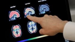 Τεχνητή νοημοσύνη προβλέπει τη νόσο Αλτσχάιμερ χρόνια πριν τη διάγνωση από τους γιατρούς
