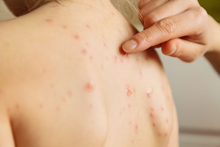 A vaccine for the varicella-zoster virus, which causes chickenpox, was introduced in the U.S. in 1995.