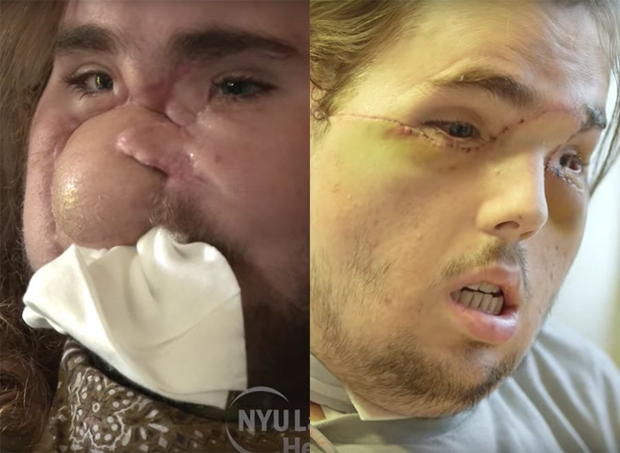 Man unveils new smile after face transplant