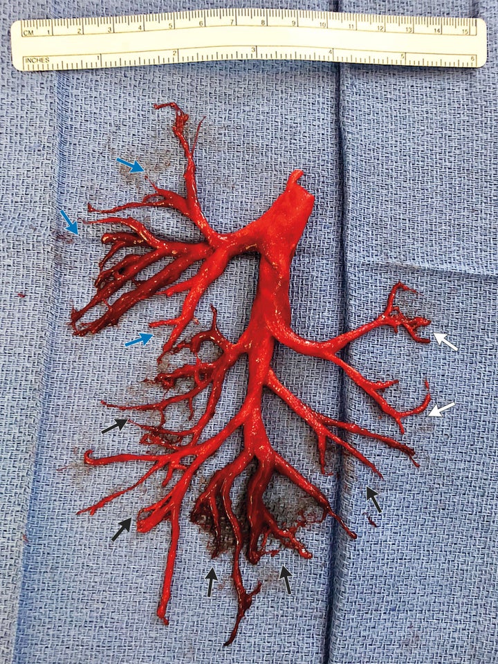 The rare blood clot, which is a cast of the right bronchial tree.