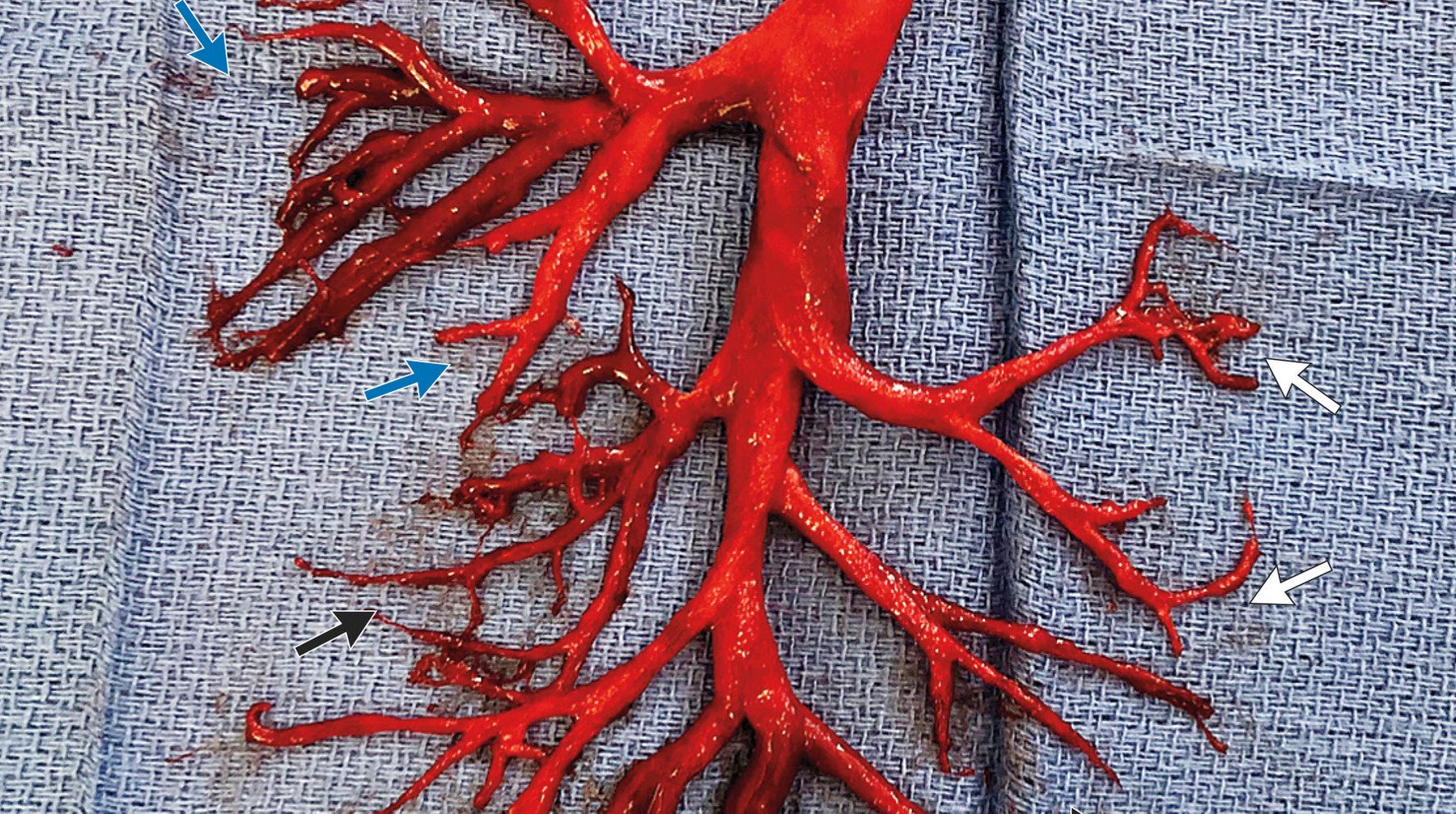 How a Huge Blood Clot Took the Shape of a Lung Passage - The Atlantic