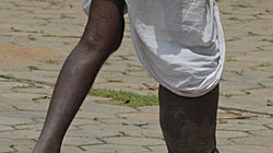 India Is Set To Fail Its Target Of Eradicating Filariasis By