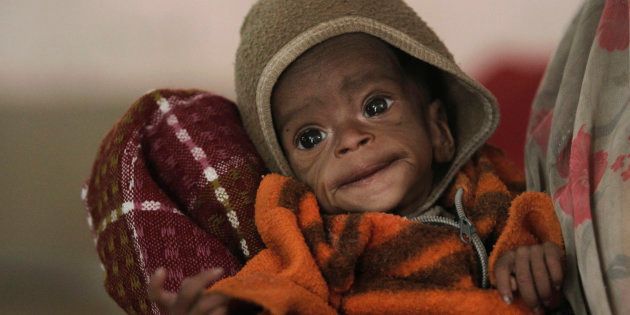 Four-month-old Vishakha, who weighs 2.3 kg (5 lbs) and suffers from severe malnutrition, is carried at the Nutritional Rehabilitation Centre of Shivpuri district in the central Indian state of Madhya Pradesh February 1, 2012.