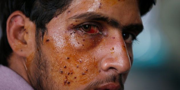 A man who got injured in the clashes between Indian police and protesters, sits inside a hospital, in Srinagar, July 14, 2016.