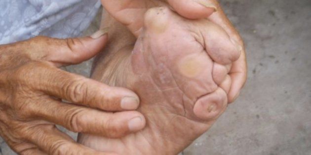 The feet of Chinese girls were broken and bound as early as the 10th century. It is widely believed that the deformed feet, which were placed in small embroidered shoes, would attract a better husband. A new study suggests feet were bound for another reason.
