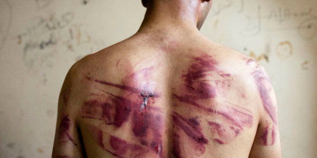A Syrian man shows marks of torture on his back, after he was released from regime forces, in the Bustan Pasha neighbourhood of Syria's northern city of Aleppo on August 23, 2012. State media hailed the recapture by the army of three Christian neighbourhoods in the heart of Aleppo, but clashes between troops and rebel fighters raged in other parts of the city and in the southern belt of Damascus. AFP PHOTO / JAMES LAWLER DUGGAN (Photo credit should read JAMES LAWLER DUGGAN/AFP/GettyImages)