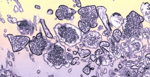 Virus Nipah in the cerebrospinal fluid of an infected patient. File photo.