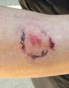 Bite marks on the victim's forearm clearly came from a human, not a dog, said police.