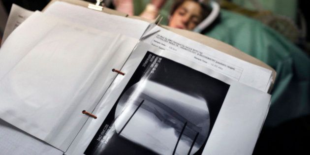 HELMAND PROVINCE, AFGHANISTAN: The x-ray of Malalia's arm prior her surgery in the operating theatre on June 9, 2007 at the British Army Field Hospital at Camp Bastion in a location in the desert in the Helmand Province in Southern Afghanistan. Malalia, a 5-year-old Afghan girl, was run over an Afghan National Army (ANA) vehicle while she was walking, and her right arm was crushed against a wall causing potentially catastrophic damage to the bone muscle and skin. She was taken directly to the operating theatre in the military field hospital and it was initially thought that an amputation was the only possible solution, however in rural Afghan society this would have resulted in her being ostracized so the surgeon promised the father that he would do everything possible to save her arm. The dead, damaged muscle was cut out and the bone was repaired with makeshift external scaffolds of wires, plastic tubing, aluminum bars and plastic ties due to the lack of specialist pediatric equipment. She required further surgery every two days for sixteen days, then a skin graft was performed. Five weeks later against, all initial expectations, the arm had healed and Malalia was able to move all her fingers and in the future she will be able to use her arm again. The British Army hospital in Camp Bastion, run by the United Kingdom Joint Force Medical Group, provides the medical cover for all ISAF personnel operating in Helmand Province in Southern Afghanistan. In addition to the British, Danish, Estonian, Czech and American troops, who operate under the command of Task Force Helmand, the British hospital treats significant numbers of Afghan patients from across the spectrum of conflict, including Afghan National Security Forces, Taliban and civilians. The hospital, although situated in a tent, is the most advanced in southern Afghanistan. (Photo by Marco Di Lauro/Getty Images)